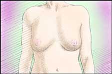 dopo l'intervento le mammelle saranno piu proporzionate al resto del corpo. Le cicatrici sono permanenti ma si affievoliscono col tempo